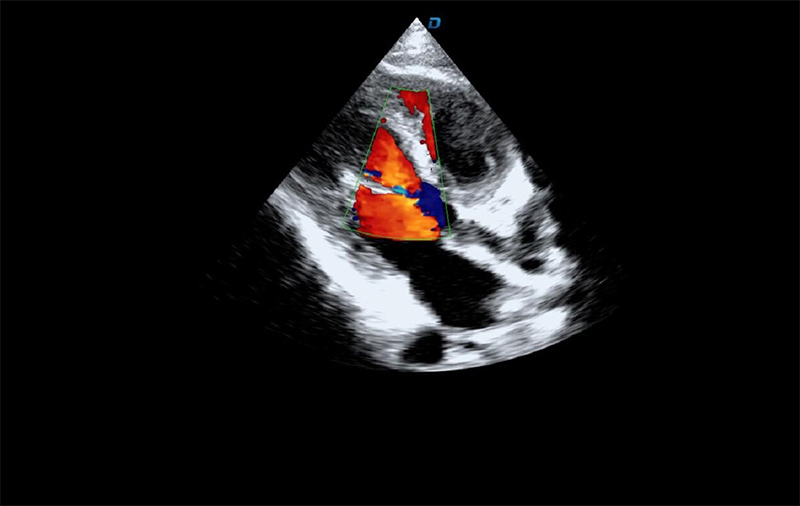 心臟彩超機(jī)檢測圖