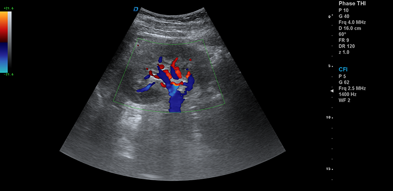 彩超機(jī)腎臟血流檢測圖