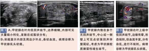 甲狀腺良性結(jié)節(jié)的特征性表現(xiàn)彩超檢測(cè)圖