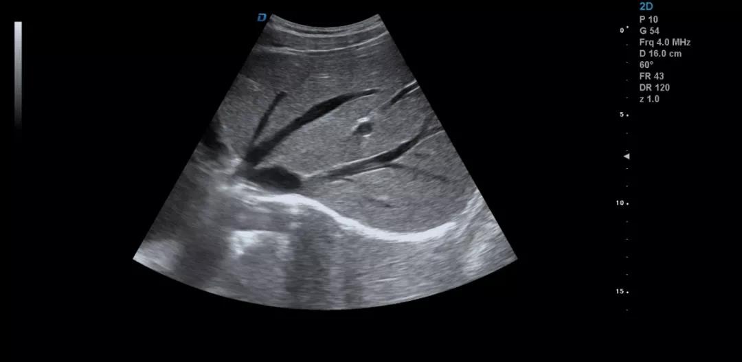 彩超機(jī)檢查肝臟超聲方法