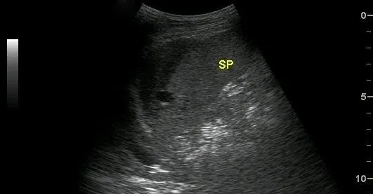 腹部超聲創(chuàng)傷性脾破裂的超聲診斷